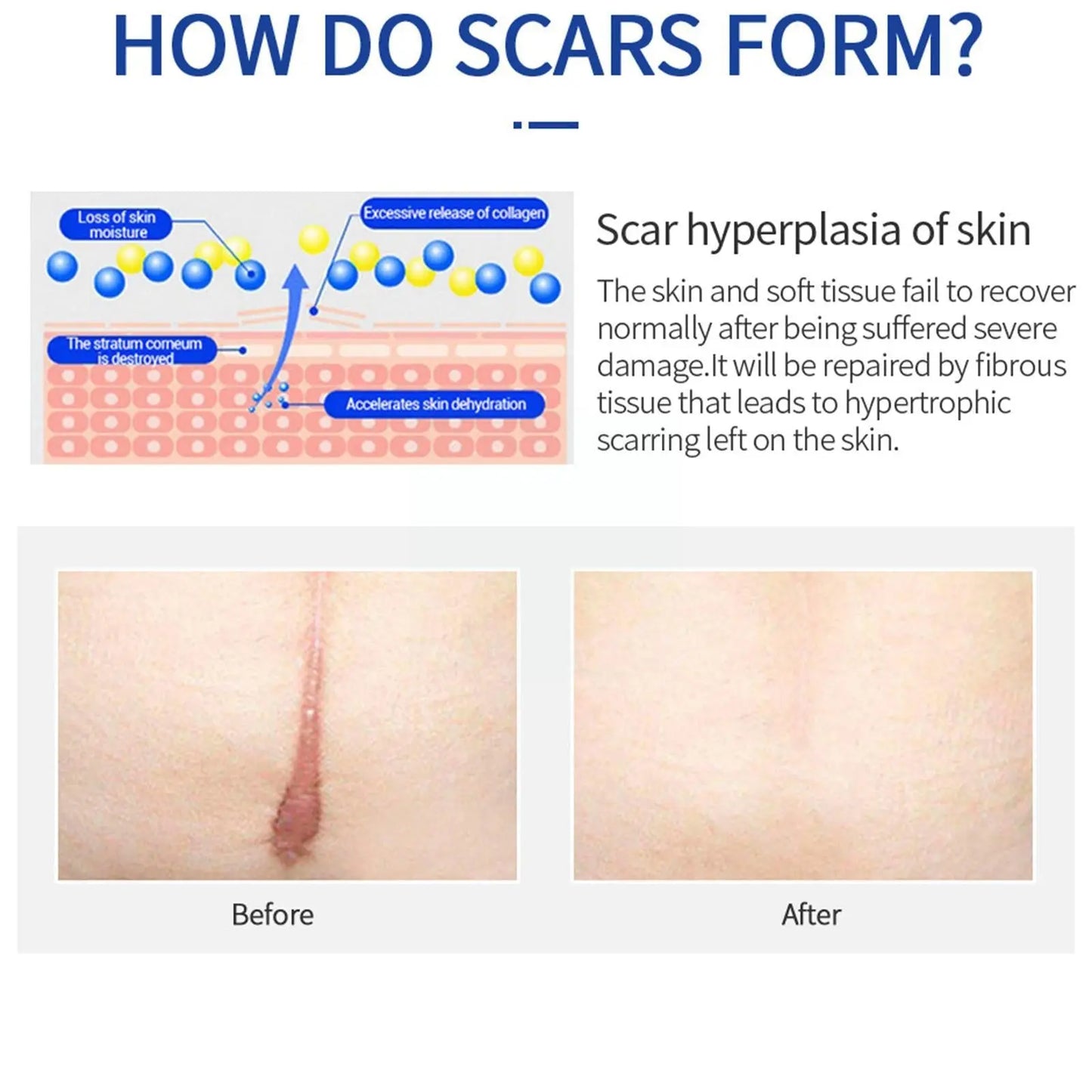 Scar Removal Cream Herbal Treatment Stretch Marks Burn Repair Acne Beauty Streetsharks